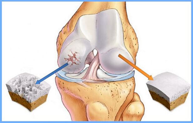 Κανονική άρθρωση του γόνατος και επηρεάζεται από οστεοαρθρίτιδα
