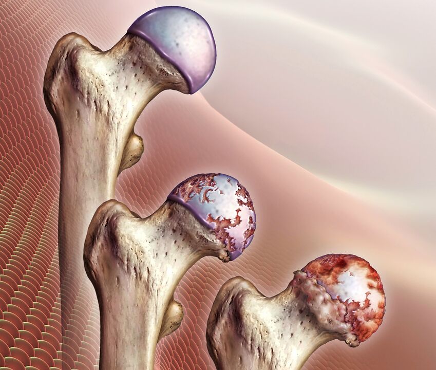 Η ανάπτυξη οστεοαρθρίτιδας της άρθρωσης του ισχίου